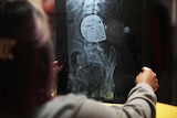 Chantelle Karo hold an x-ray to the light as she looks at the pain relief pump inside her body