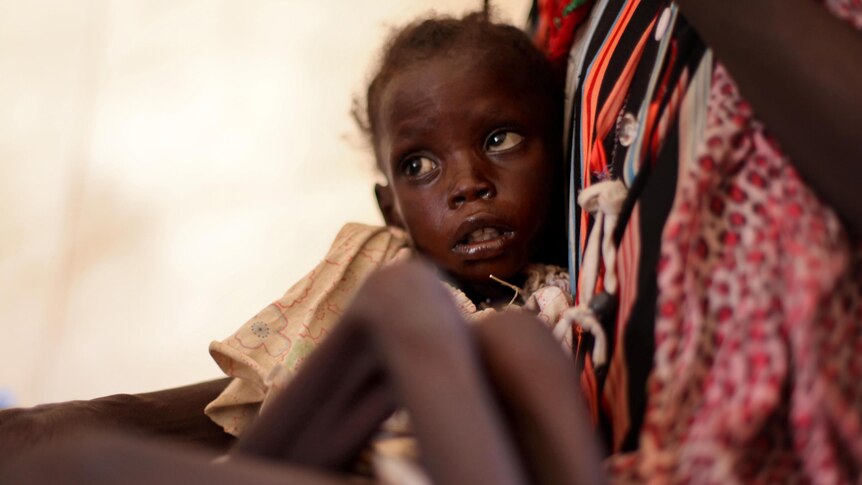 Malnourished child in Doro refugee camp in South Sudan.