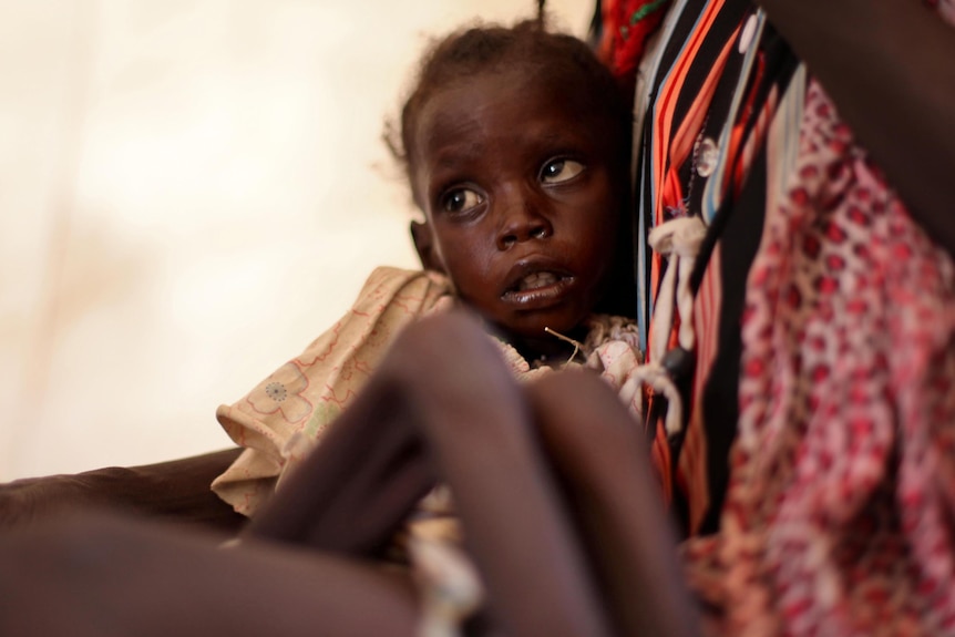 Malnourished child in Doro refugee camp in South Sudan.