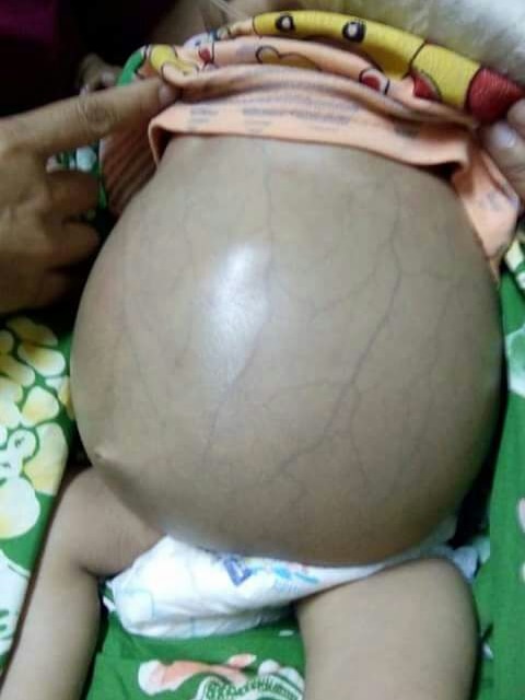 Baby's swollen abdomen as twin foetus grows inside it.