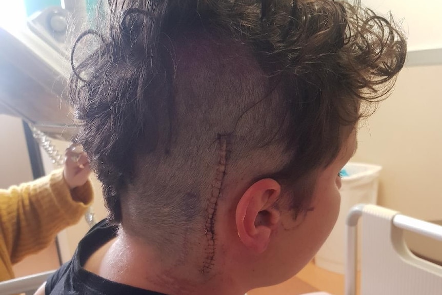 A boy with some hair on his head shaved and stitches