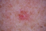 Basal cell carcinoma on a patient, as seen through a dermatoscope, in March 2016