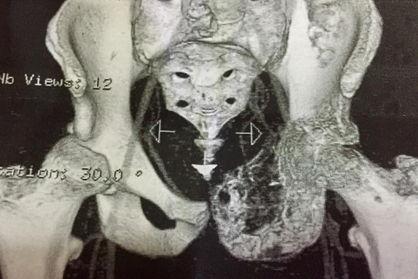 An MRI scan of bone cancer patient Rhys Habermann.