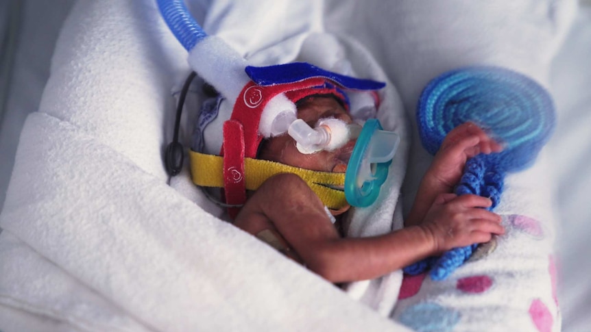 A close up shows baby Garvik in the Mercy Hospital's neonatal intensive care unit.