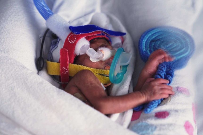 A close up shows baby Garvik in the Mercy Hospital's neonatal intensive care unit.