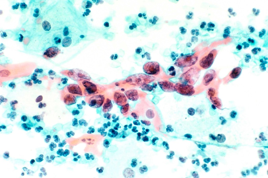 Cervical cancer cells