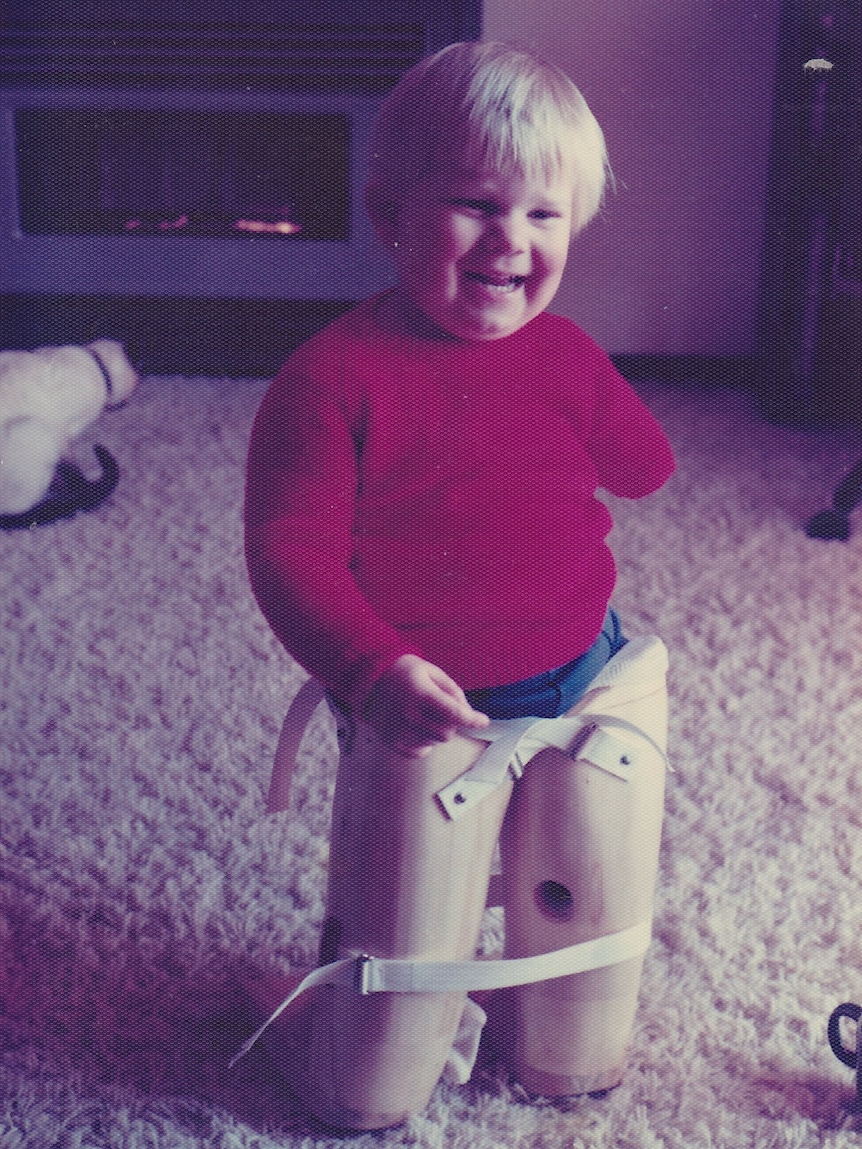 A young boy around 3 years old with prosthetic legs