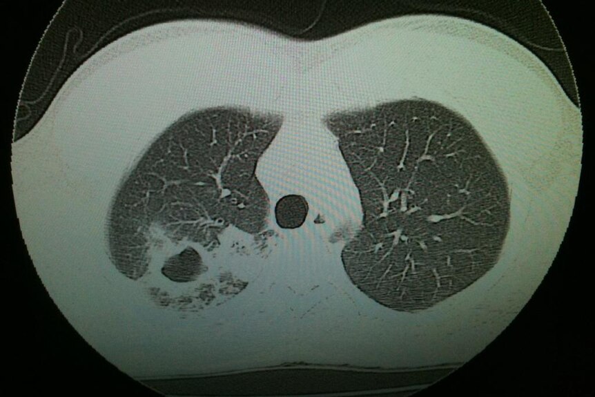 X-Ray of Christiaan Van Vuuren's lungs showing TB