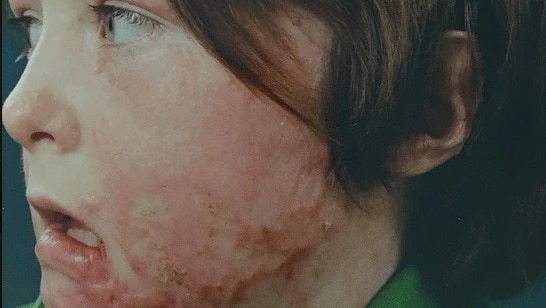 A child with facial burns