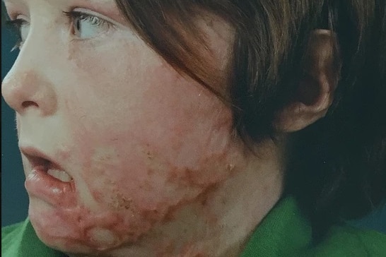 A child with facial burns