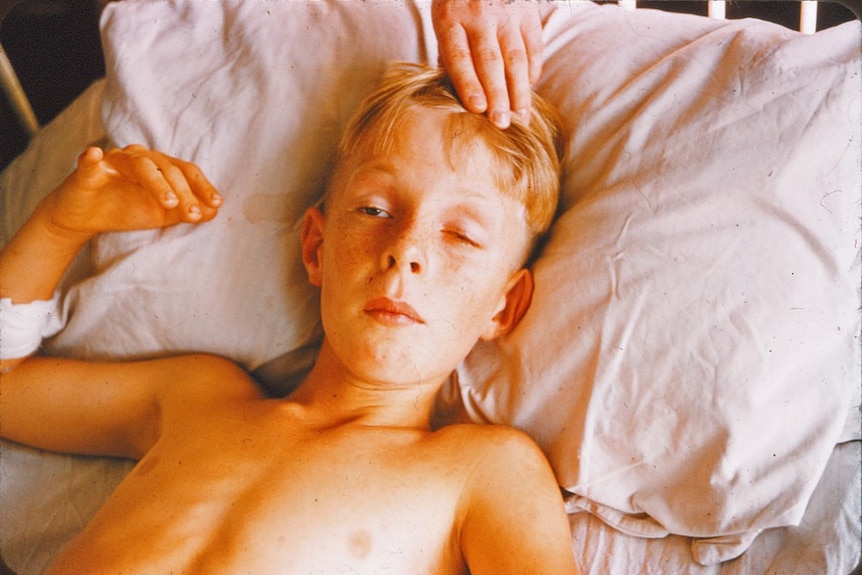 A young boy laying in bed with his left eye lid swollen shut 