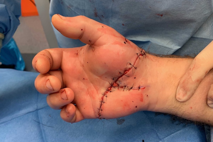 A hand with visible joins and stitching from where it was reattached to the wrist.