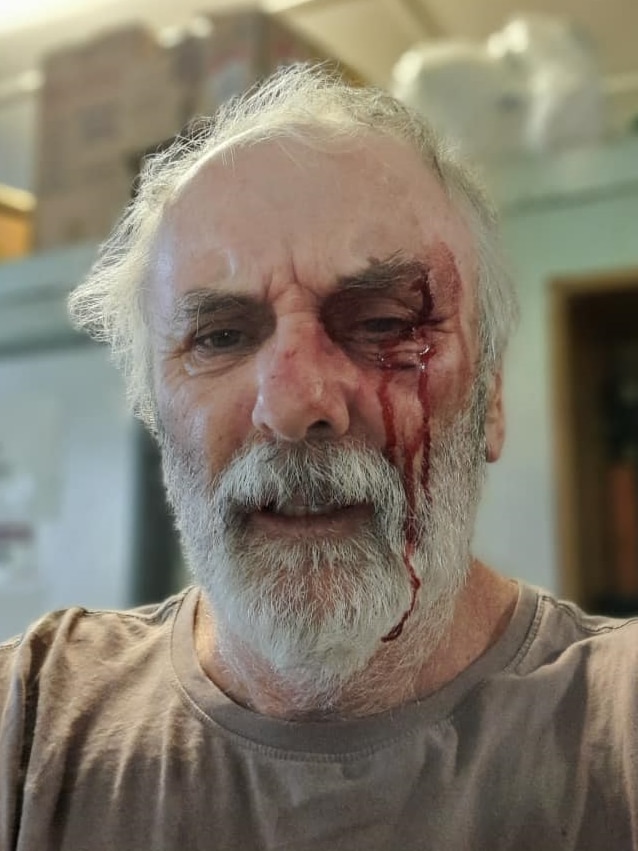 An elderly man with blood coming from his eye