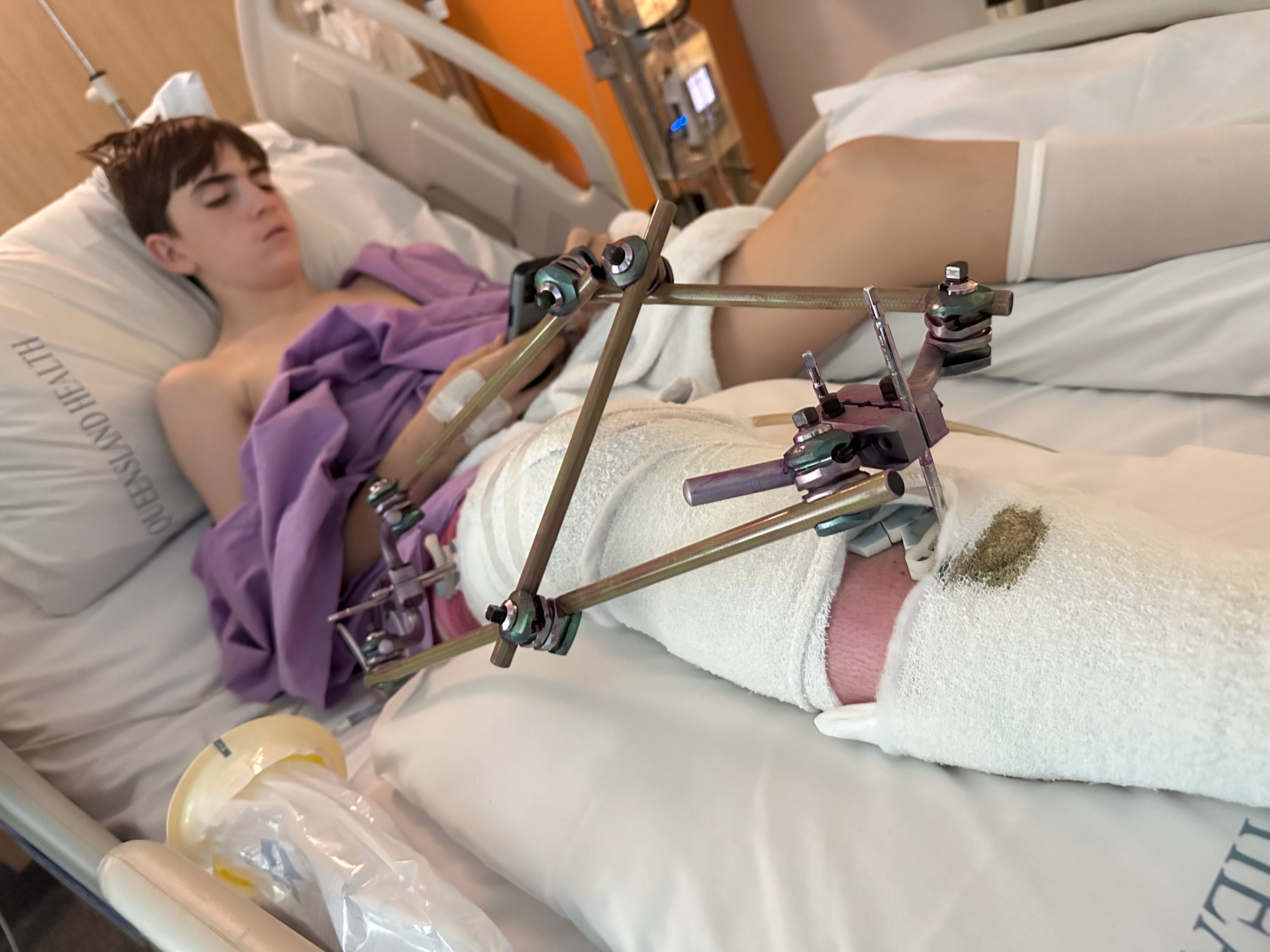 A teenage boy lies in a hospital bed with pins in his leg after surgery.