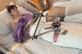 A teenage boy lies in a hospital bed with pins in his leg after surgery.