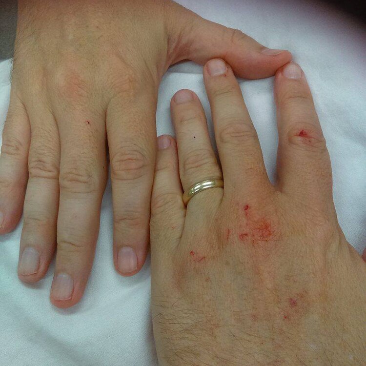 Mark Rose's injured hands after a runaway horse rips through his car roof