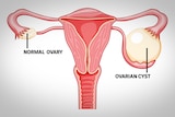 A diagram showing a uterus with fallopian tubes and an enlarged circular shape on one side 