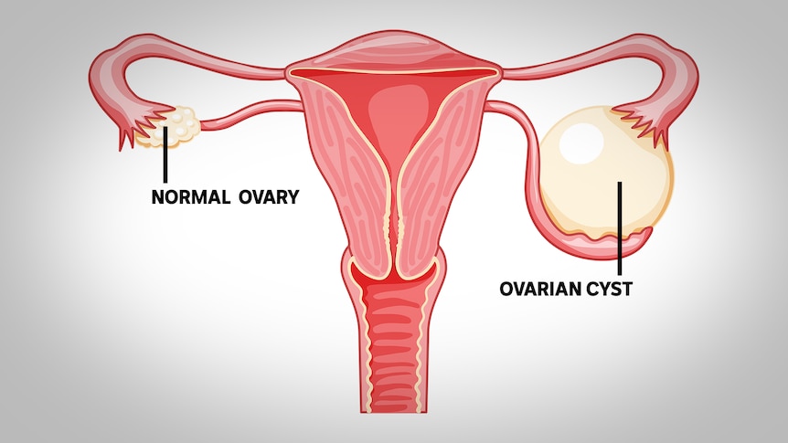 A diagram showing a uterus with fallopian tubes and an enlarged circular shape on one side 