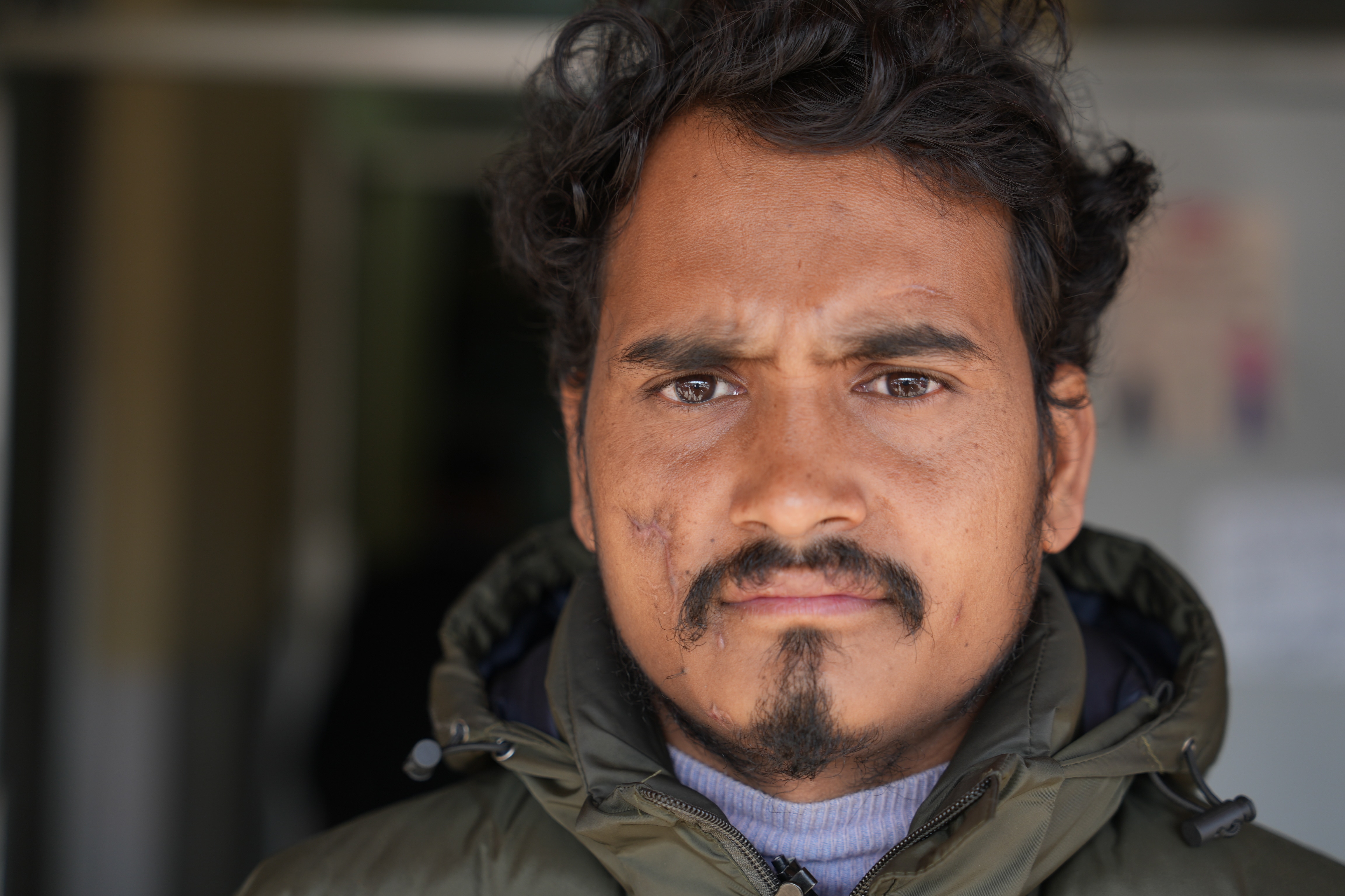 A Nepali man with a scar on his face 