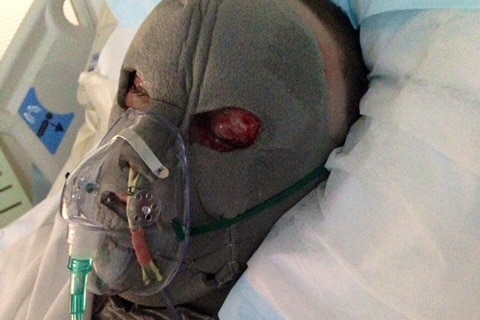 Matthew Richards in hospital wearing a face mask over burns.