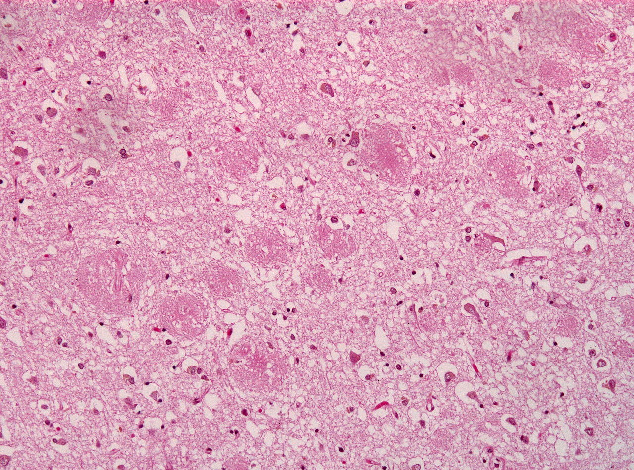 Test that could identify Alzheimer's signs 20 years earlier greenlit for trials