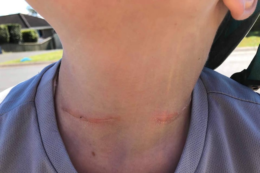 A close up photo of a neck with a red friction burn mark about 10cm long.
