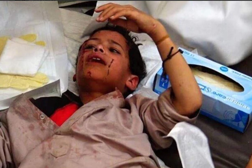 Child lying on bed with blood on his face