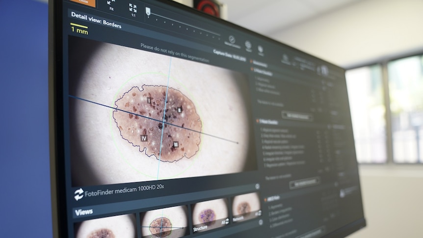 A computer screen showing a medical photograph of a close up section of a skin cancer.