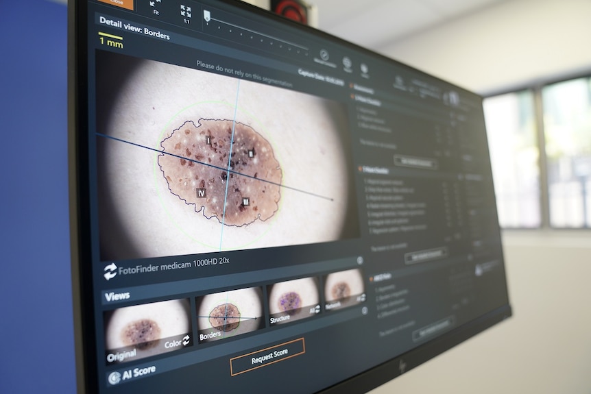 A computer screen showing a medical photograph of a close up section of a skin cancer.