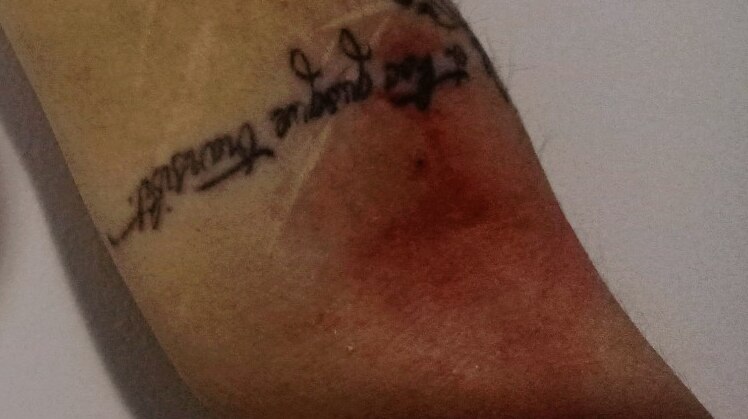 Red and purple bruises on a woman's arm