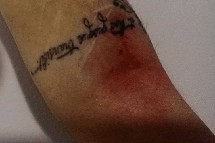 Red and purple bruises on a woman's arm