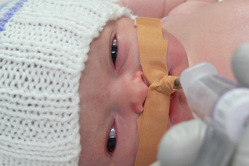 Close-up of newborn Eleanor Holland with tube taped to her face