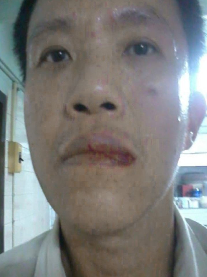 Close up of up kachai Hongkangwan showing his injuries, including a busted lip