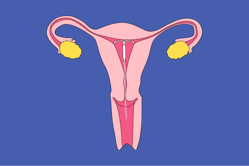 An illustration of an IUD sitting in the uterus.