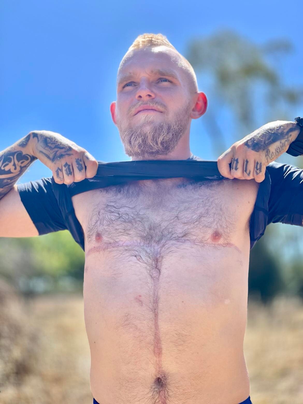 A man holding up his shirt showing his chest with a scar on it