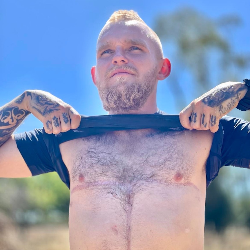 A man holding up his shirt showing his chest with a scar on it