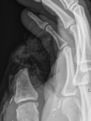 An x-ray showing a missing thumb.