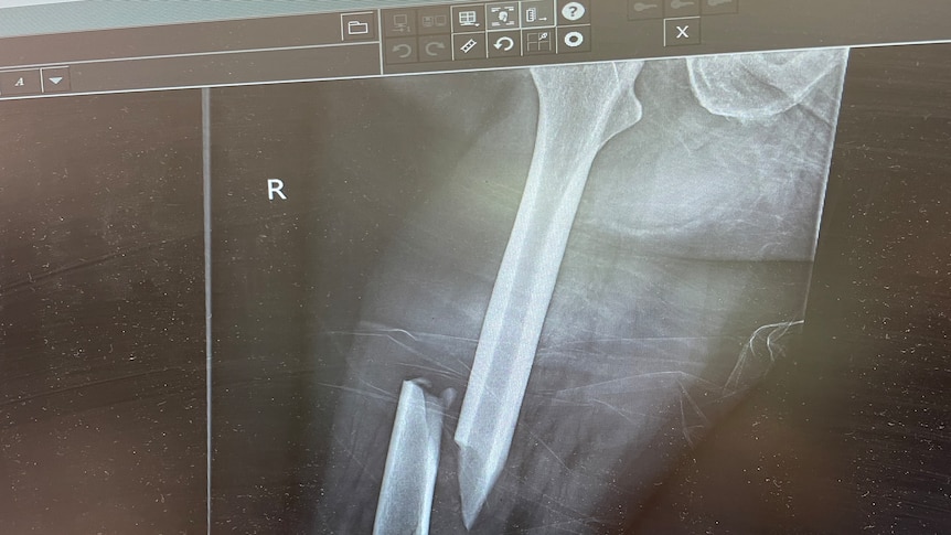 An x-ray showing a broken femur.