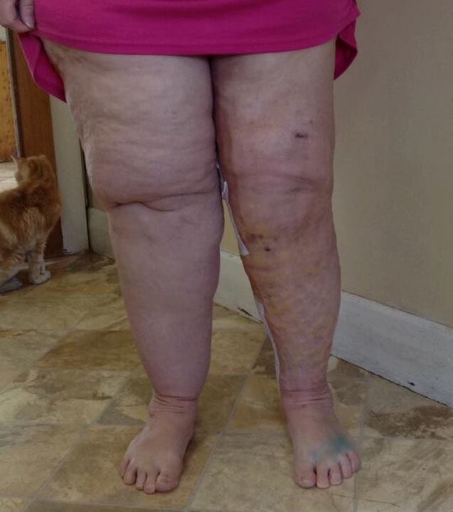 woman's uneven-sized legs, her right leg significantly heavier than her left. She is wearing red shorts