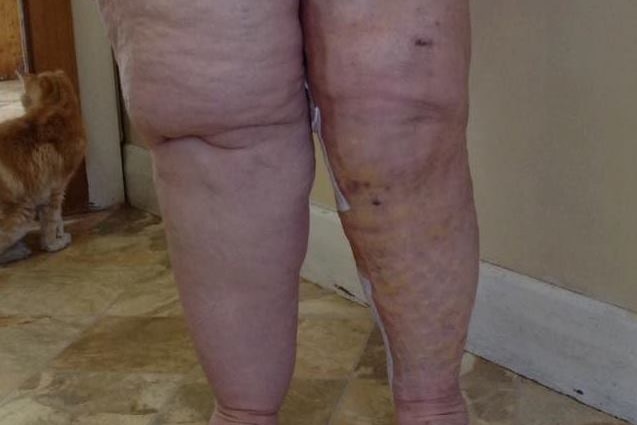 woman's uneven-sized legs, her right leg significantly heavier than her left. She is wearing red shorts