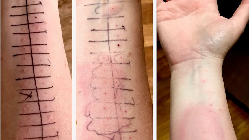 Nikki Atack's arms covered in red welts after allergy skin prick testing.