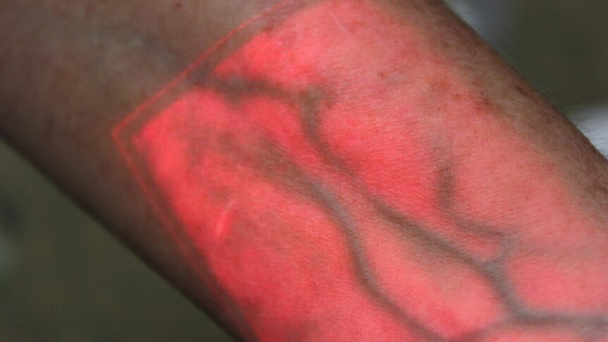 Veins on an arm show up under a red light