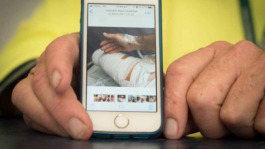 A photo of a bandaged leg with the foot amputated displayed on a mobile phone held in a man's hands