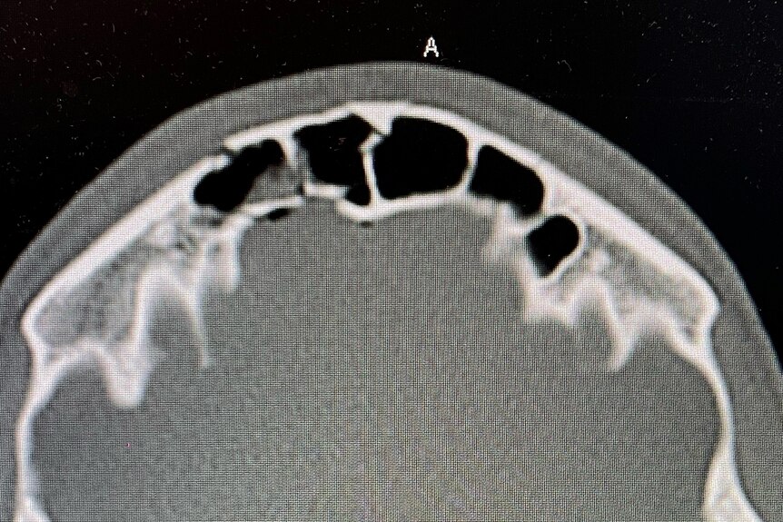 CT scan showing fractured skull of left hand side