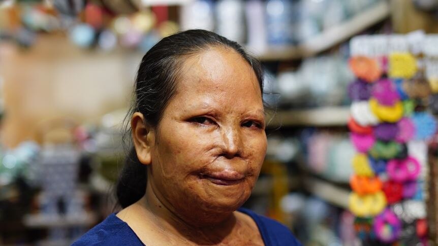 A Cambodian woman with a scarred face and a deep blue top standing in a marketplace.