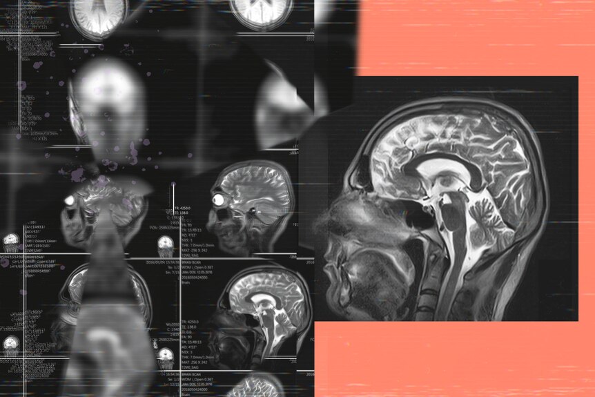 A graphic collage of pictures shows grainy MRI brain scan images on a coral background