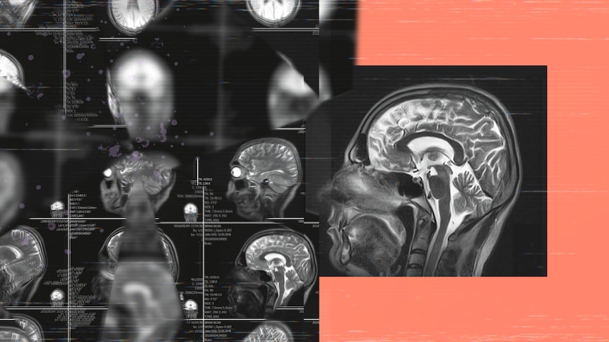 A graphic collage of pictures shows grainy MRI brain scan images on a coral background