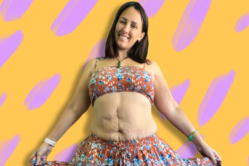 Woman in crop top and skirt smiling, showing stretch marks on stomach, in story about post-baby body acceptance.