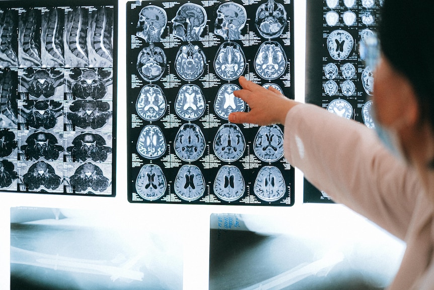 Scans of the brain on a lightbox 