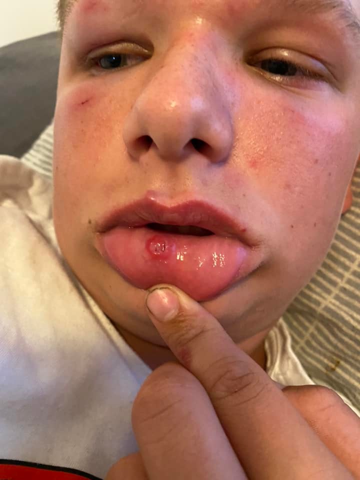 Boy with facial bruising and cut lip.